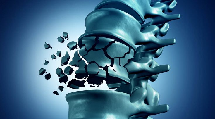 Osteoporose Häufigkeit