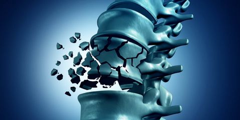 Osteoporose Häufigkeit