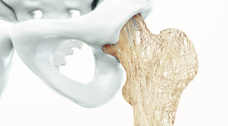 Osteoporose 