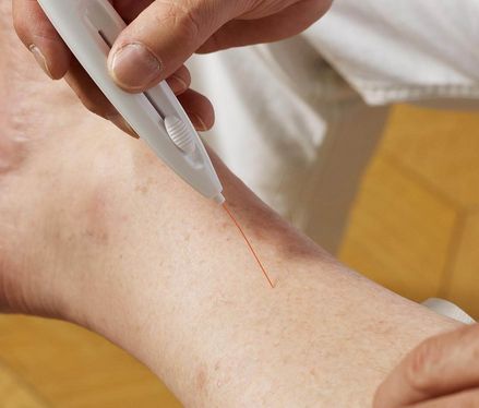Polyneuropathie – 5 Fragen an den Experten Dr. med. Michael Annas