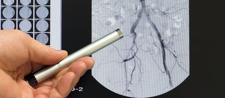 Gefäßverengung: Behandlung mit Ballon und Katheter