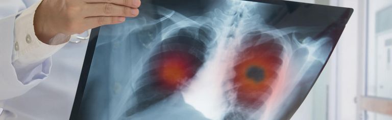 Röntgenbild bei Bronchialkarzinom