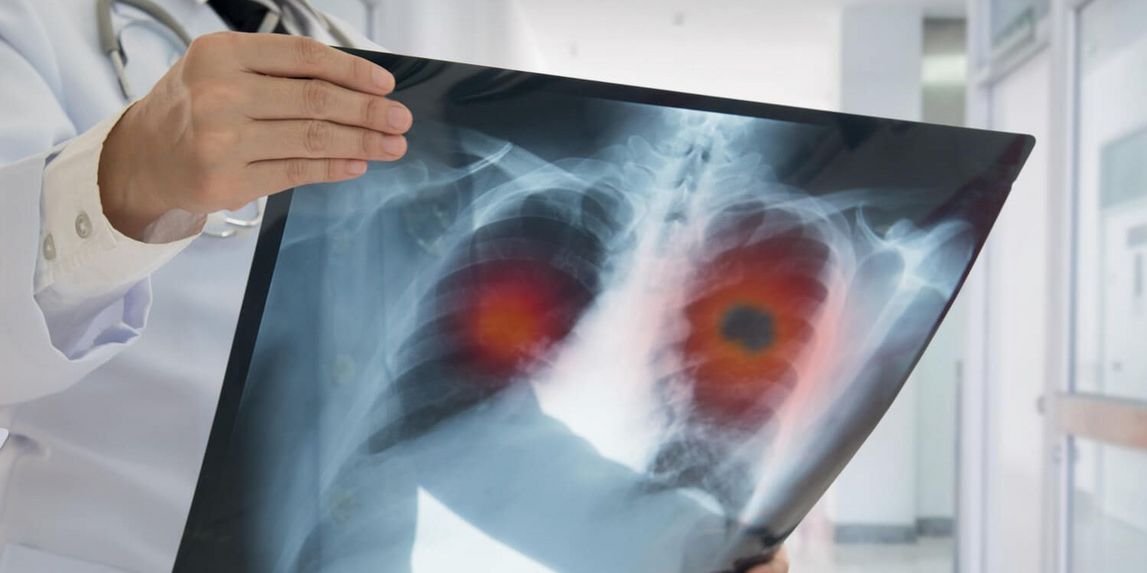 Röntgenbild bei Bronchialkarzinom