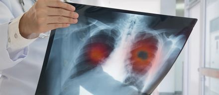 Bronchialkarzinom (Lungenkrebs) – Symptome, Ursachen, Behandlung & Lebenserwartung