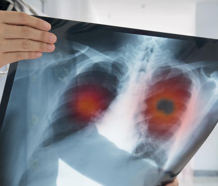 Bronchialkarzinom (Lungenkrebs) – Symptome, Ursachen, Behandlung & Lebenserwartung