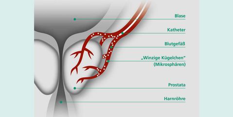 Prostataembolisation Prostataembolisation