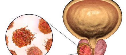 Prostatakrebs – Diagnose, Symptome & Behandlung