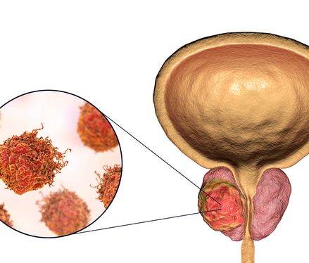 Prostatakrebs – Diagnose, Symptome & Behandlung