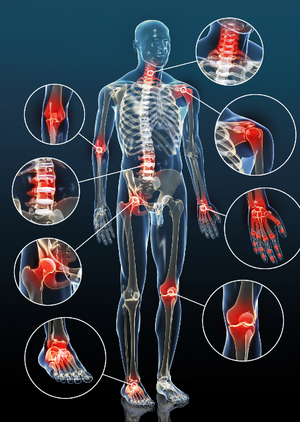 Arthrose am Körper