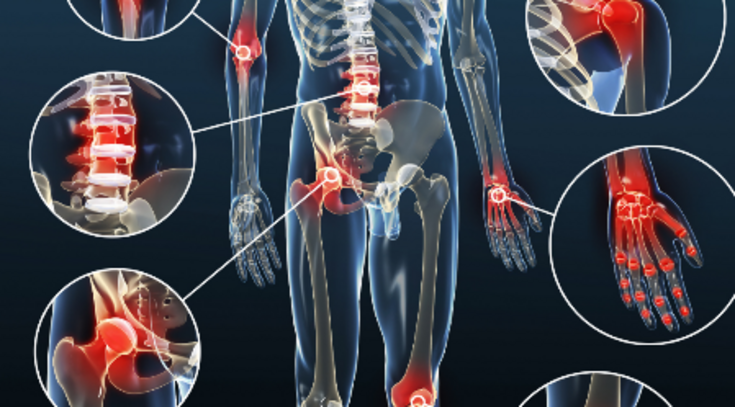 Arthrose am Körper