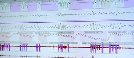 Schnarchen – ein Symptom des Schlafapnoesyndroms