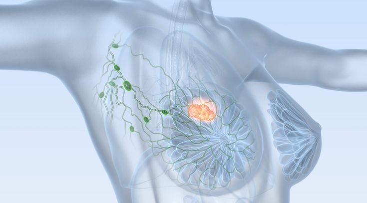 Tumor in der Brust