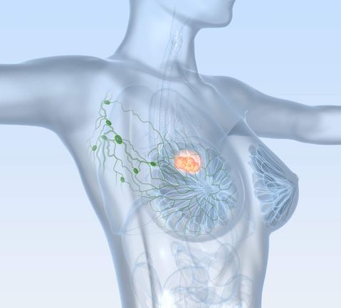 Tumor in der Brust Tumor in der Brust