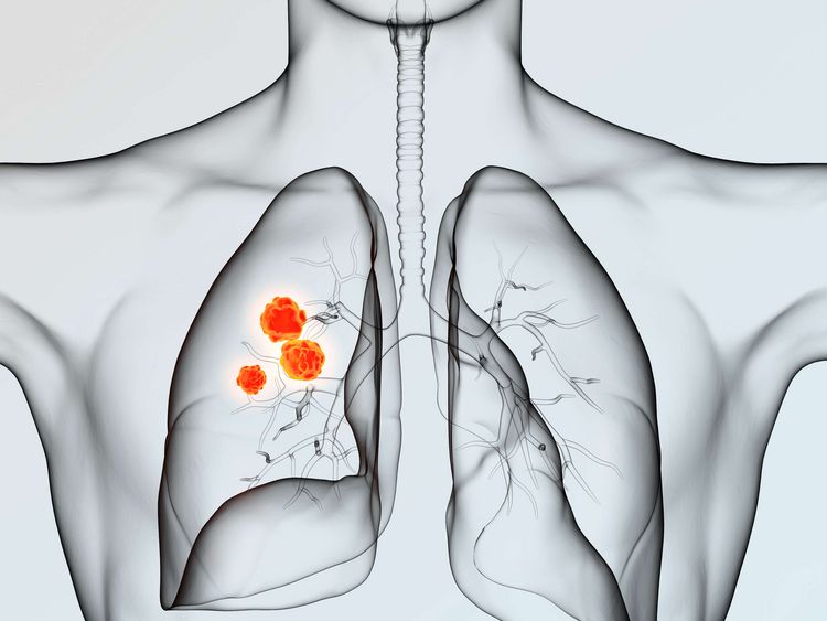Bronchialkarzinom Lungenkrebs