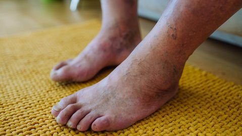 Diabetischer Fuß bei Polyneuropathie Füße eines Diabetes-Patienten