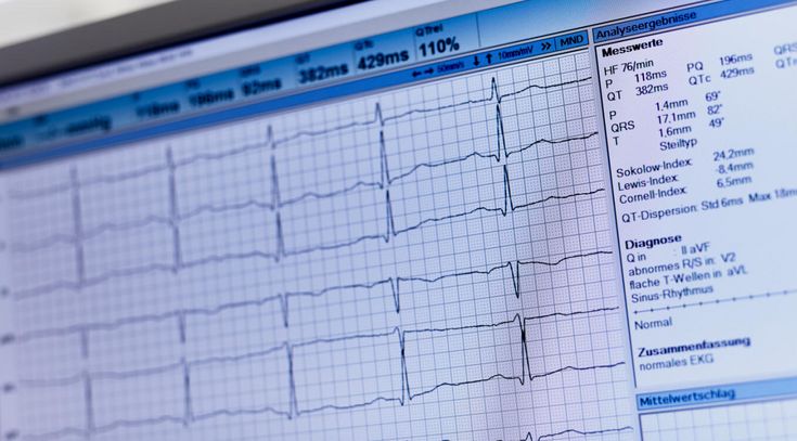 EKG Herzrhythmusstörungen