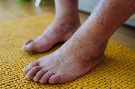 Diabetischer Fuß - Füße eines Diabetes-Patienten