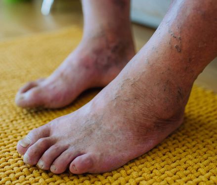 Diabetischer Fuß: Risikofaktoren, Symptome, Behandlung & Vorbeugung