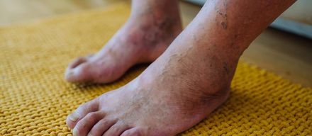 Diabetischer Fuß - Behandlung und Vorbeugung Diabetischer Fuß: Risikofaktoren, Symptome, Behandlung & Vorbeugung