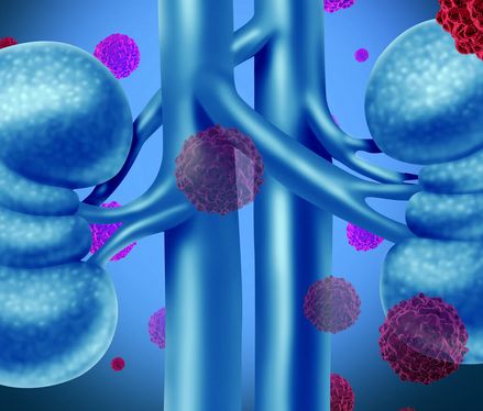 Nierenkrebs – Risikofaktoren, Symptome & Behandlung