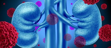 Nierenkrebs – Risikofaktoren, Symptome & Behandlung