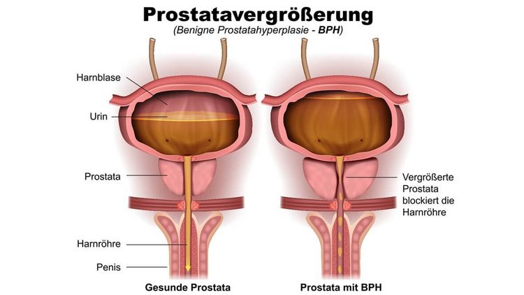 Vergrößerte Prostata