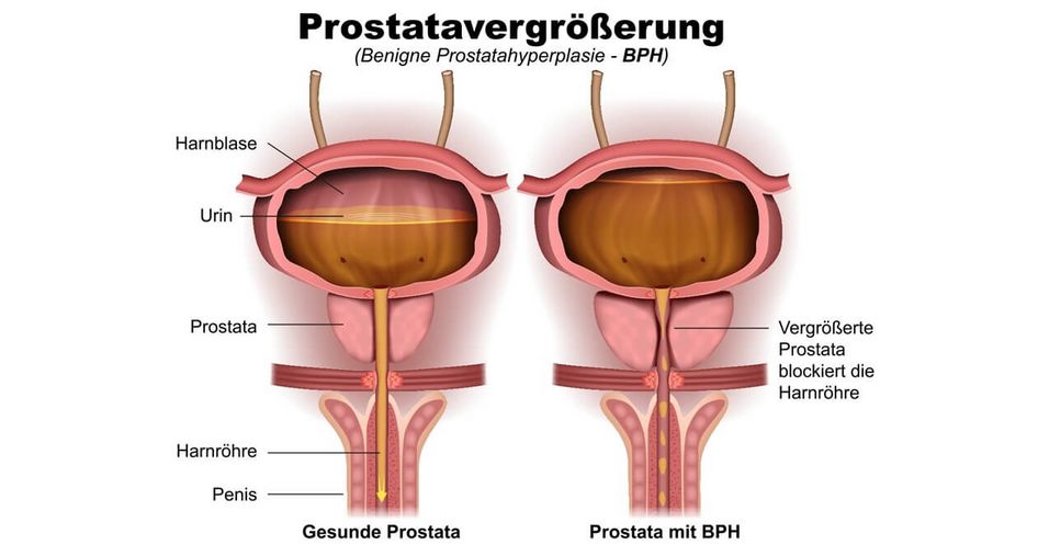 Vergrößerte Prostata
